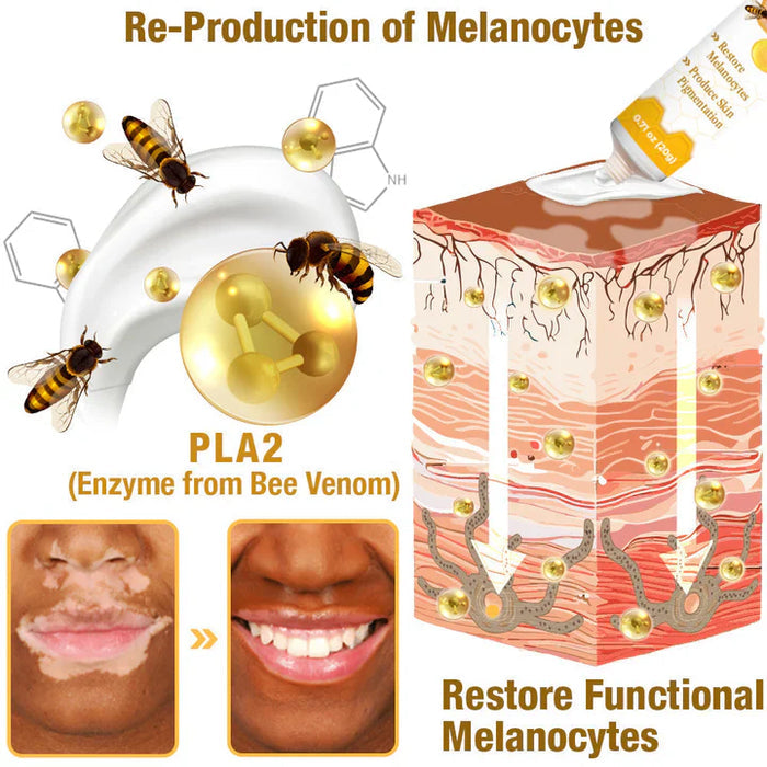 ELITEPRO™ BEE VENOM VITILIGO TREATMENT CREAM Wart Tag Remover