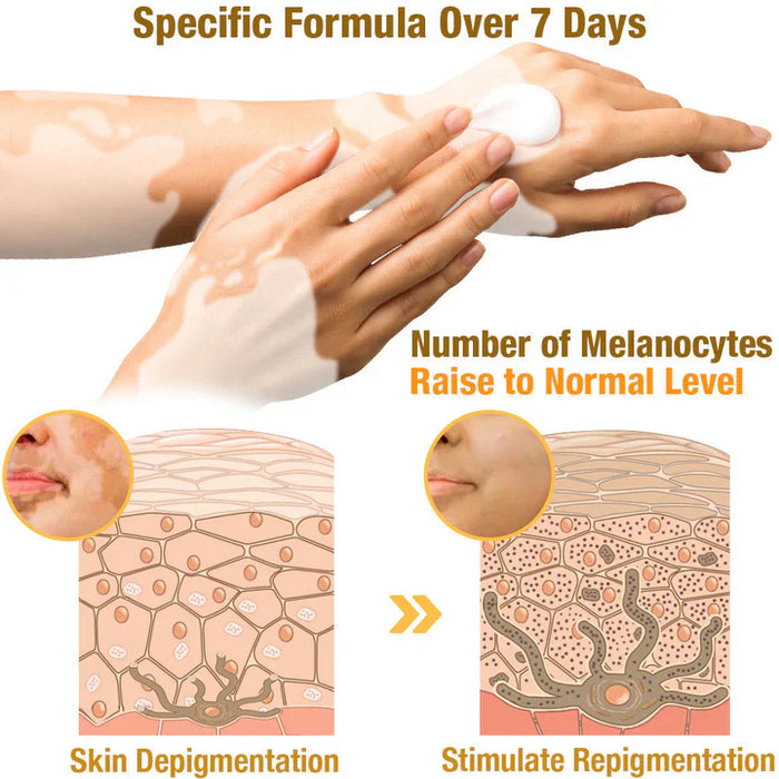 ELITEPRO™ BEE VENOM VITILIGO TREATMENT CREAM Wart Tag Remover