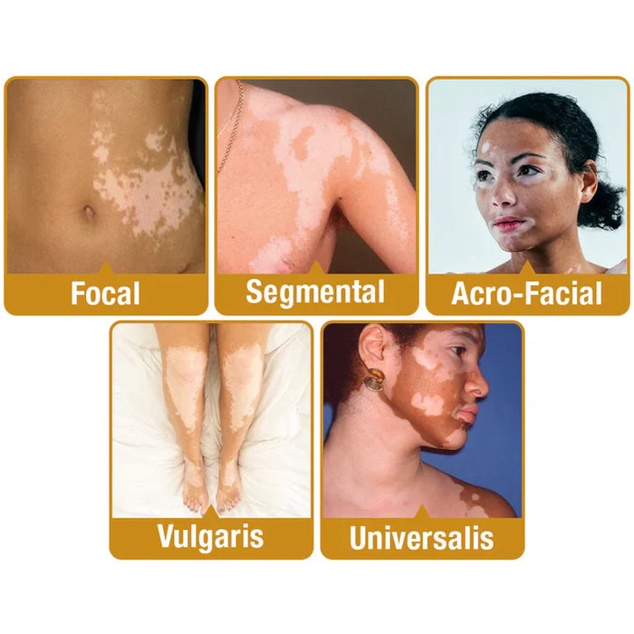 ELITEPRO™ BEE VENOM VITILIGO TREATMENT CREAM Wart Tag Remover