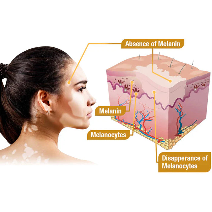 ELITEPRO™ BEE VENOM VITILIGO TREATMENT CREAM Wart Tag Remover