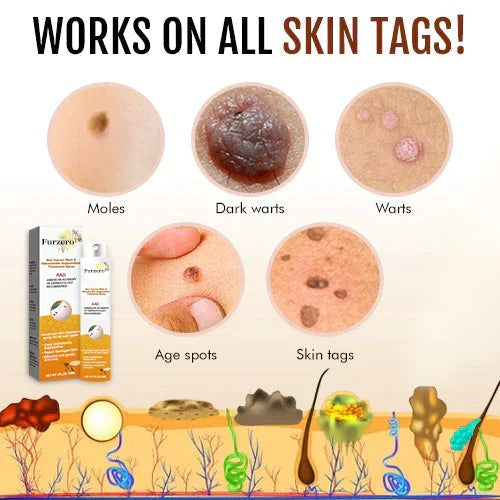 ELITEPRO™ BEE VENOM VITILIGO TREATMENT CREAM Wart Tag Remover