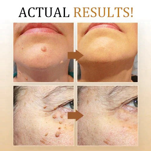 Tags & Moles Remover