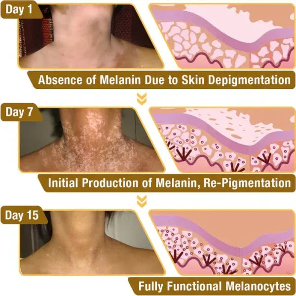ELITEPRO™ BEE VENOM VITILIGO TREATMENT CREAM