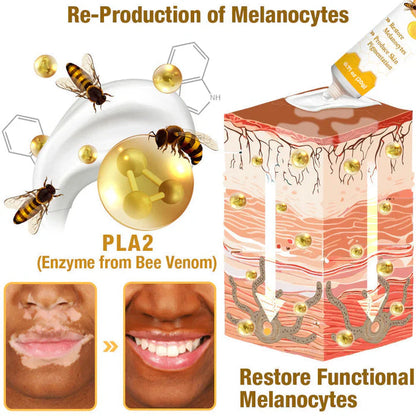 ELITEPRO™ BEE VENOM VITILIGO TREATMENT CREAM Wart Tag Remover