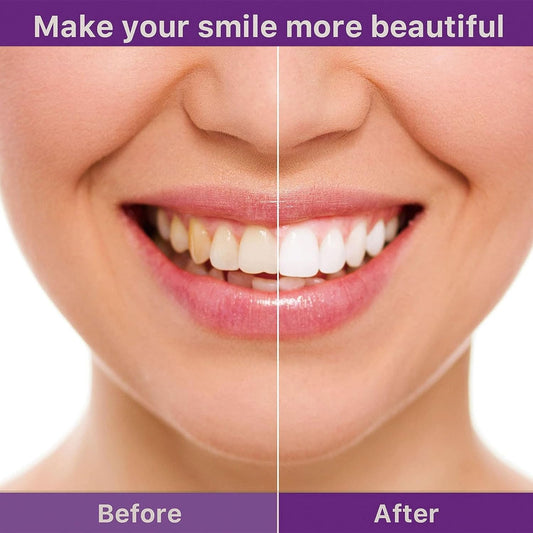 Hismile V34 Teeth Brightening