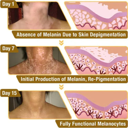 ELITEPRO™ BEE VENOM VITILIGO TREATMENT CREAM